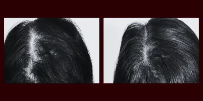 Before and after hair transplant images showing improved hair density