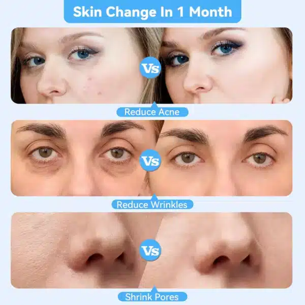 Before and after results of using a Diamond microdermabrasion machine to reduce acne, wrinkles, and shrink pores