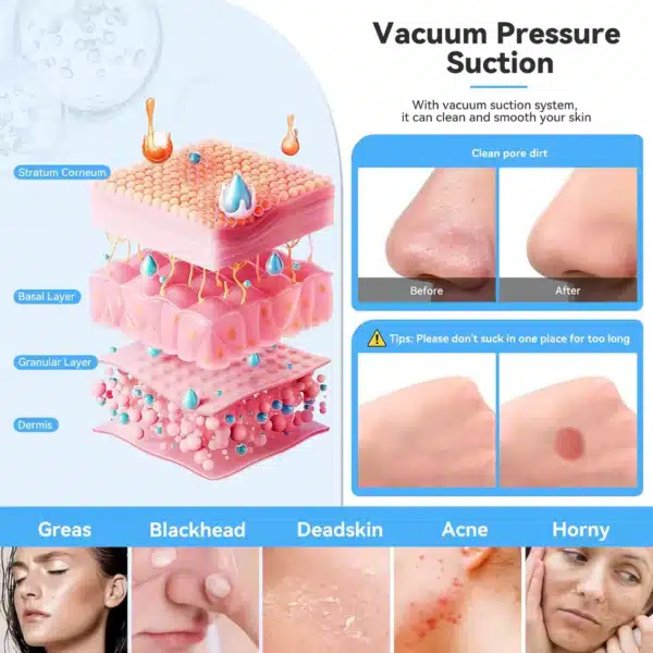 Skin layer diagram showing vacuum pressure suction from diamond microdermabrasion machine