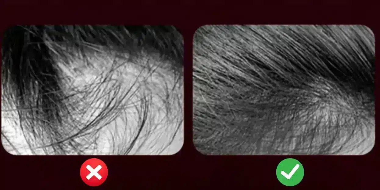 Before and after hair transplant images compared to electric scalp massager hair growth results